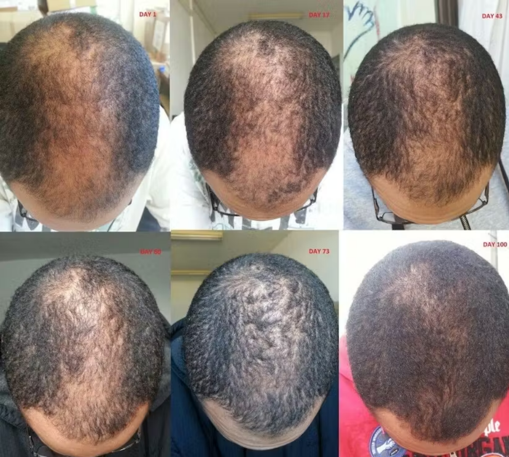 Hair Regrowth Oil & Shampoo